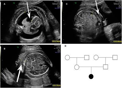 Case Report: Whole Exome Sequencing Revealed Two Novel Mutations of PIEZO1 Implicated in Nonimmune Hydrops Fetalis